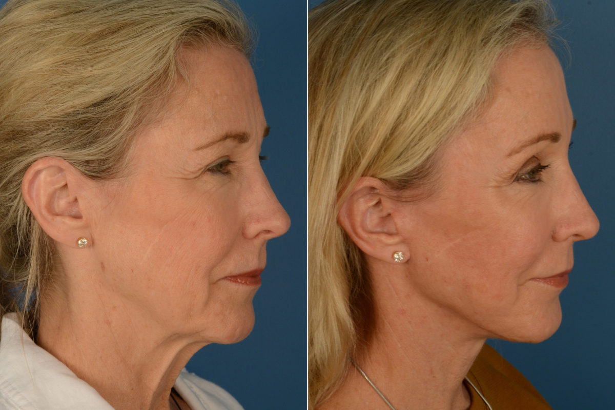 Fat Transfer Before and After Photos in Naples, FL, Patient 16903