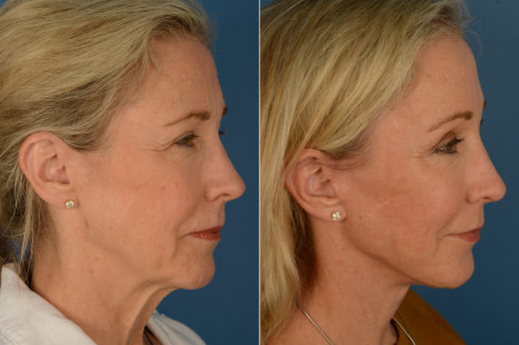 The UpLift™ Lower Face and Neck Lift Before and After Photos in Naples, FL, Patient 16903