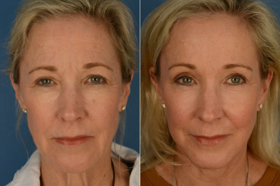 The UpLift™ Lower Face and Neck Lift Before and After Photos in Naples, FL, Patient 16903