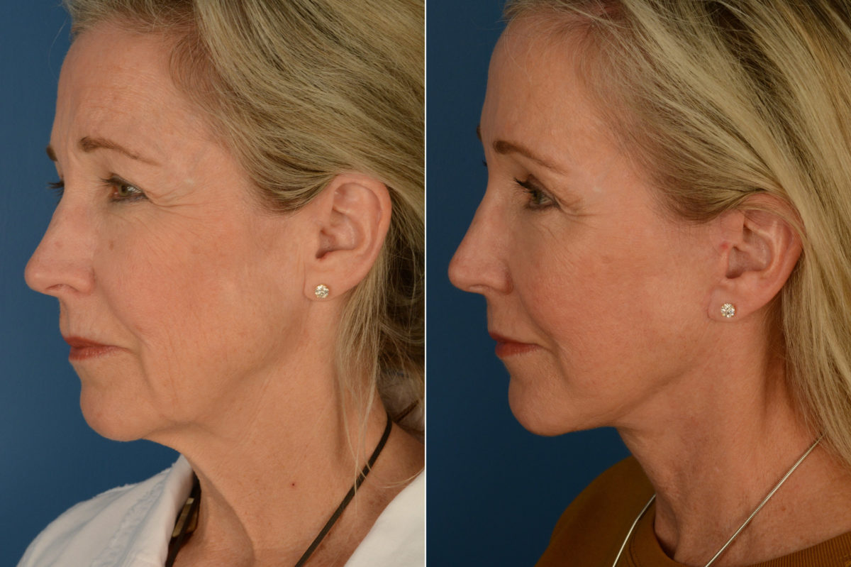 Fat Transfer Before and After Photos in Naples, FL, Patient 16903