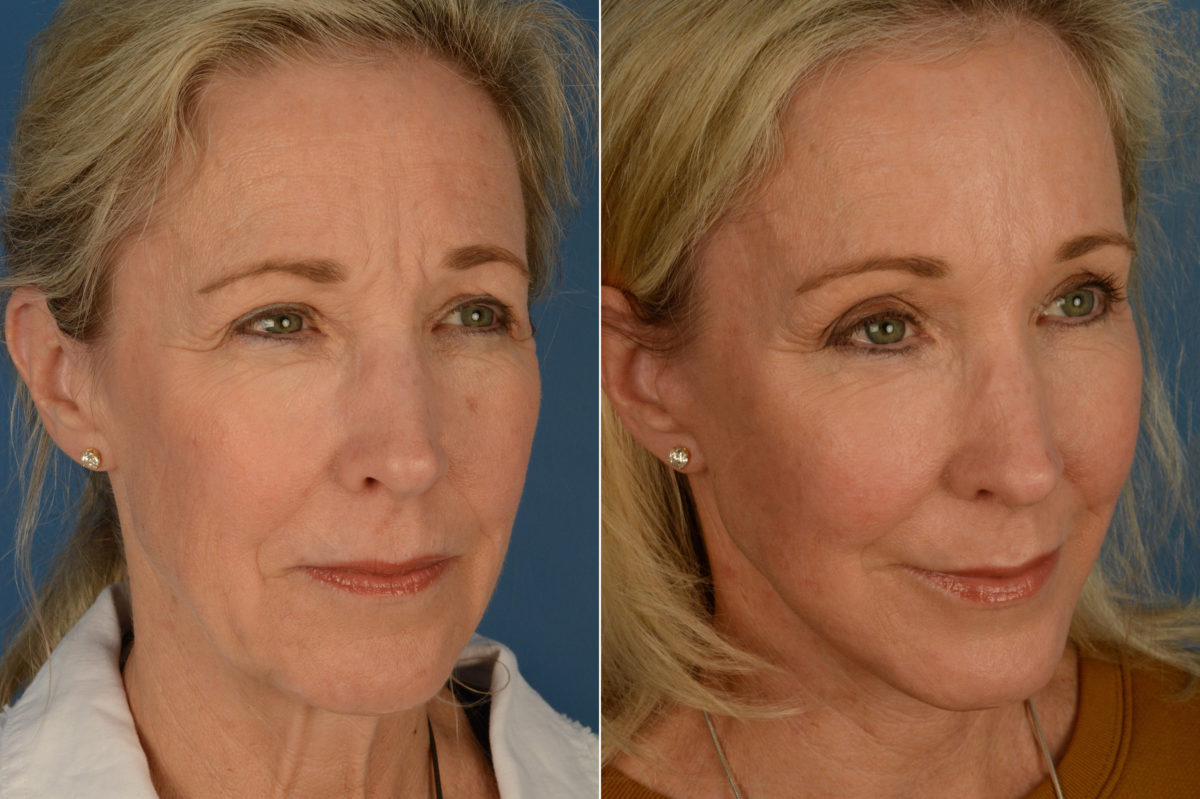 Fat Transfer Before and After Photos in Naples, FL, Patient 16903