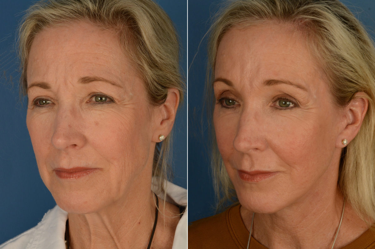 Fat Transfer Before and After Photos in Naples, FL, Patient 16903