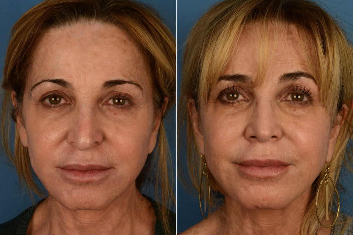 Revision Rhinoplasty Before and After Photos in Naples, FL, Patient 16944