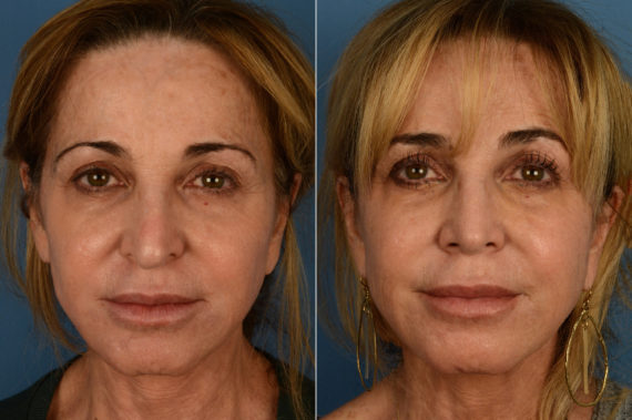 Revision Rhinoplasty Before and After Photos in Naples, FL, Patient 16944