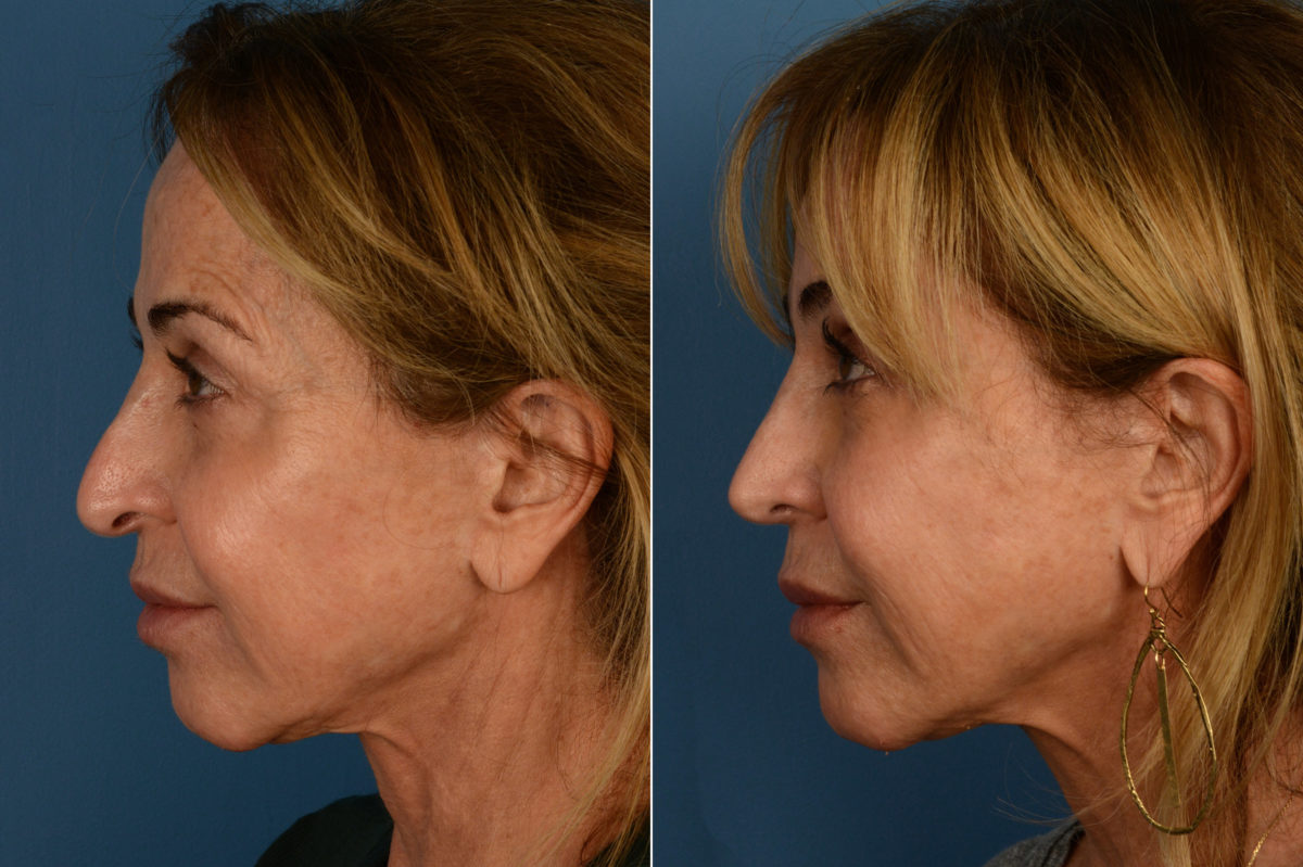 Revision Rhinoplasty Before and After Photos in Naples, FL, Patient 16944