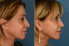 Revision Rhinoplasty Before and After Photos in Naples, FL, Patient 16944