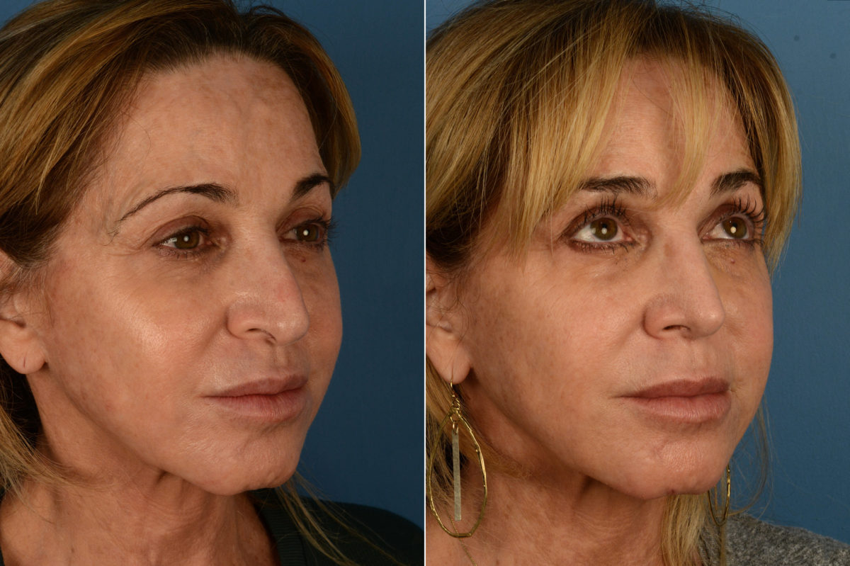 Revision Rhinoplasty Before and After Photos in Naples, FL, Patient 16944