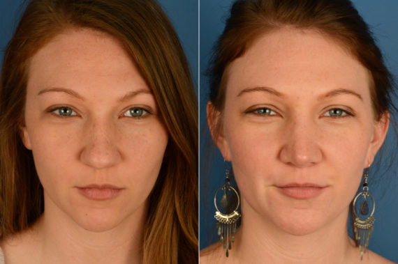 Rhinoplasty Before and After Photos in Naples, FL, Patient 16957