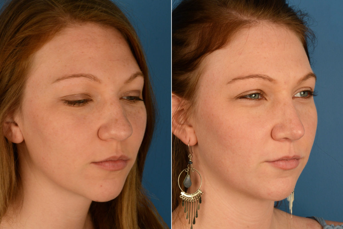 Rhinoplasty Before and After Photos in Naples, FL, Patient 16957