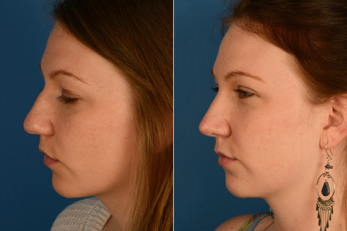 Rhinoplasty Before and After Photos in Naples, FL, Patient 16957
