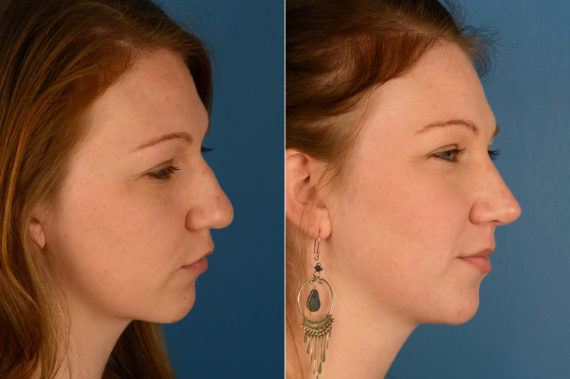 Rhinoplasty Before and After Photos in Naples, FL, Patient 16957
