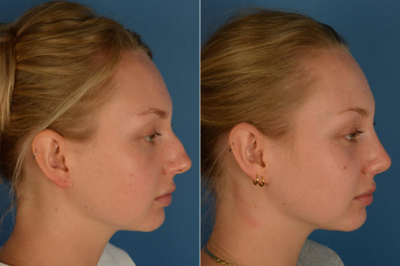 Rhinoplasty Before and After Photos in Naples, FL, Patient 16990