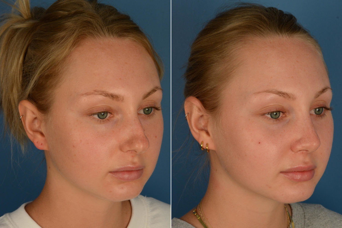 Rhinoplasty Before and After Photos in Naples, FL, Patient 16990