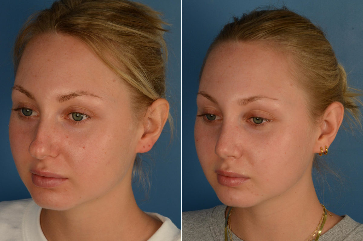 Rhinoplasty Before and After Photos in Naples, FL, Patient 16990