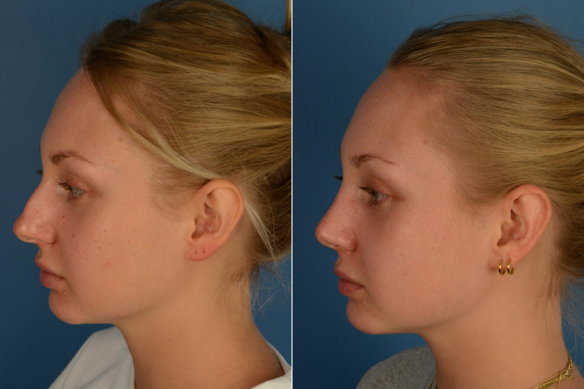 Rhinoplasty Before and After Photos in Naples, FL, Patient 16990