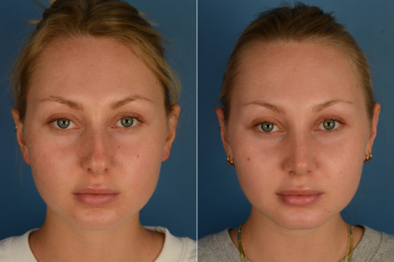 Rhinoplasty Before and After Photos in Naples, FL, Patient 16990