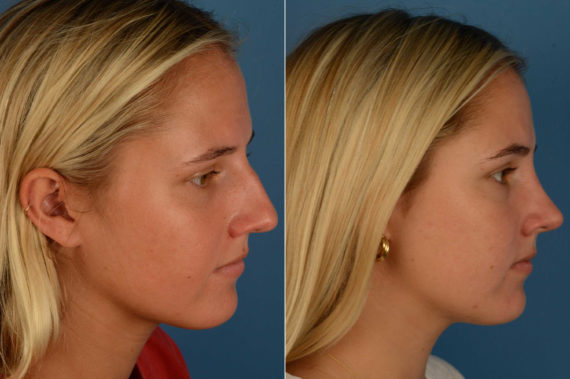 Rhinoplasty Before and After Photos in Naples, FL, Patient 17076