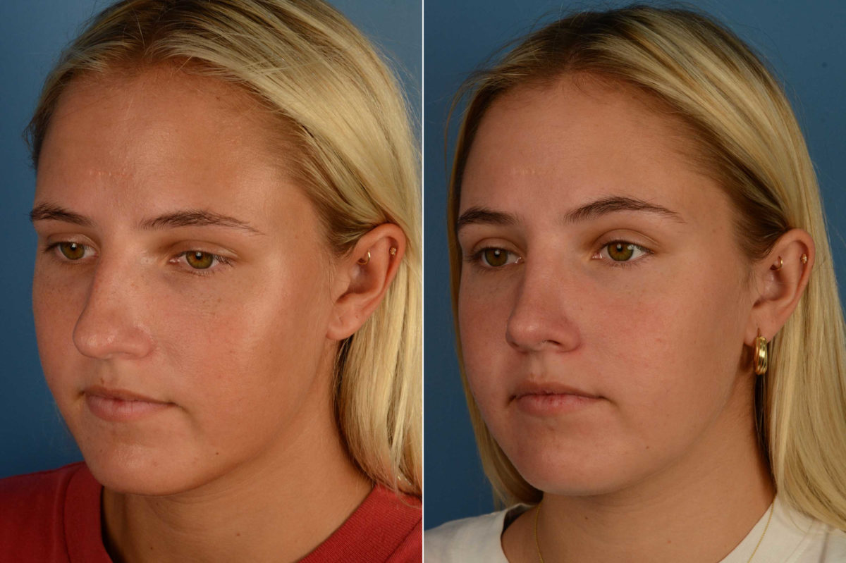 Rhinoplasty Before and After Photos in Naples, FL, Patient 17076