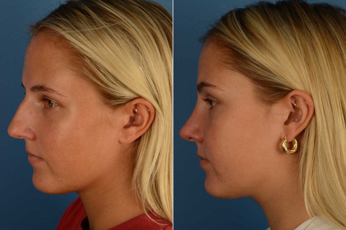 Rhinoplasty Before and After Photos in Naples, FL, Patient 17076