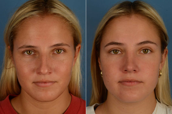 Rhinoplasty Before and After Photos in Naples, FL, Patient 17076