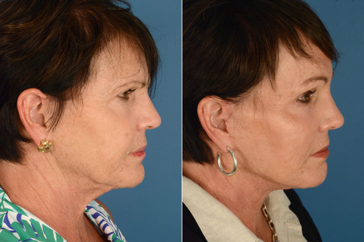 Endoscopic Facelift Before and After Photos in Naples, FL, Patient 18726