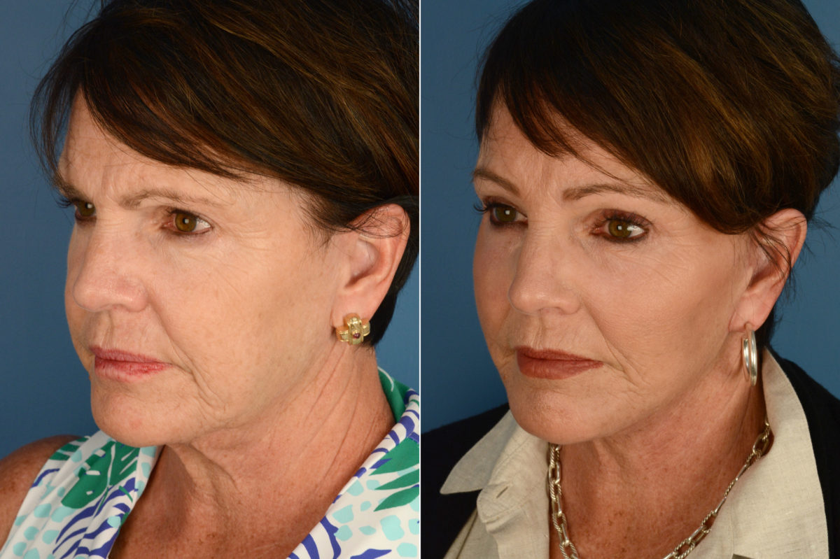 Endoscopic Facelift Before and After Photos in Naples, FL, Patient 18726