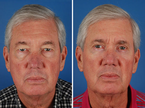 How to Fix Tired-Looking Eyes, Before and After Photos Blepharoplasty Male Before and After Photos in Naples, FL, Patient 8290