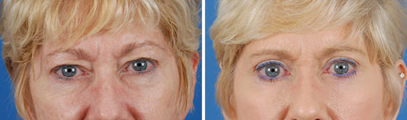 Blepharoplasty Before and After Photos in Naples, FL, Patient 8295