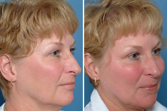 Artic Laser Wash Before and After Photos in Naples, FL, Patient 8301