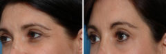 Botox Before and After Photos in Naples, FL, Patient 8304