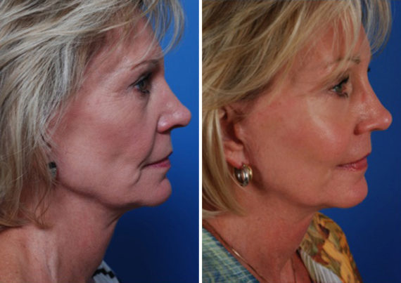 Cheek Implants Before and After Photos in Naples, FL, Patient 8316