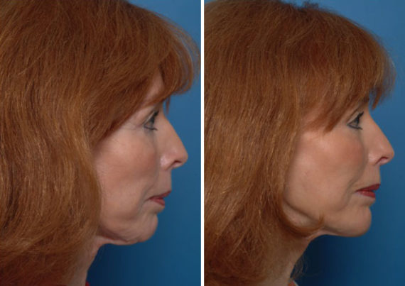 Chin Implant Before and After Photos in Naples, FL, Patient 8321