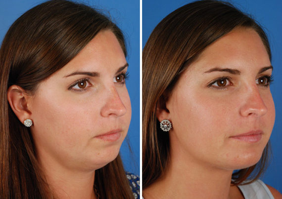 Chin Implant Before and After Photos in Naples, FL, Patient 8324