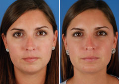 Chin Implant Before and After Photos in Naples, FL, Patient 8324