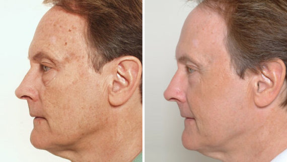 CO2 Laserwash Before and After Photos in Naples, FL, Patient 8333