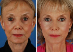 CO2 Laserwash Before and After Photos in Naples, FL, Patient 8340