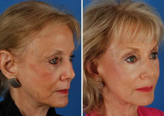 CO2 Laserwash Before and After Photos in Naples, FL, Patient 8340