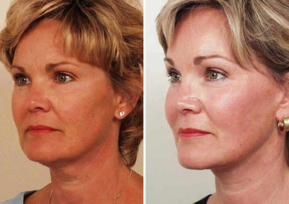 Endoscopic Facelift Before and After Photos in Naples, FL, Patient 8347