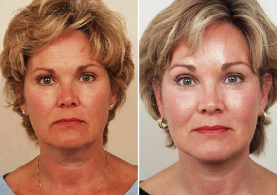 Endoscopic Facelift Before and After Photos in Naples, FL, Patient 8347