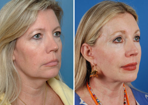 Endoscopic Facelift Before and After Photos in Naples, FL, Patient 8354