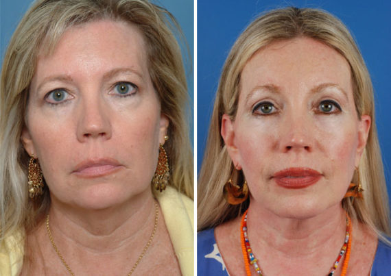 Endoscopic Facelift Before and After Photos in Naples, FL, Patient 8354