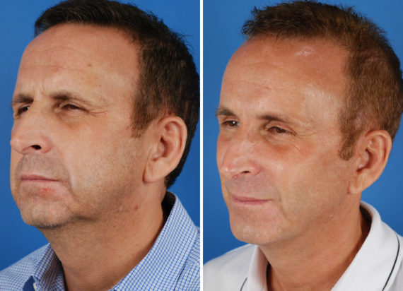 Endoscopic Facelift Before and After Photos in Naples, FL, Patient 8361