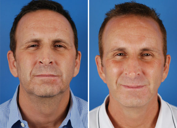 Endoscopic Facelift Before and After Photos in Naples, FL, Patient 8361