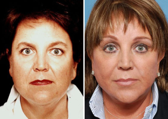 Endoscopic Facelift Before and After Photos in Naples, FL, Patient 8370