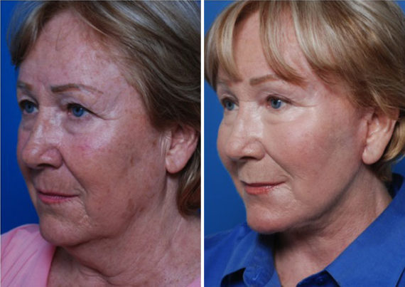 Endoscopic Facelift Before and After Photos in Naples, FL, Patient 8377