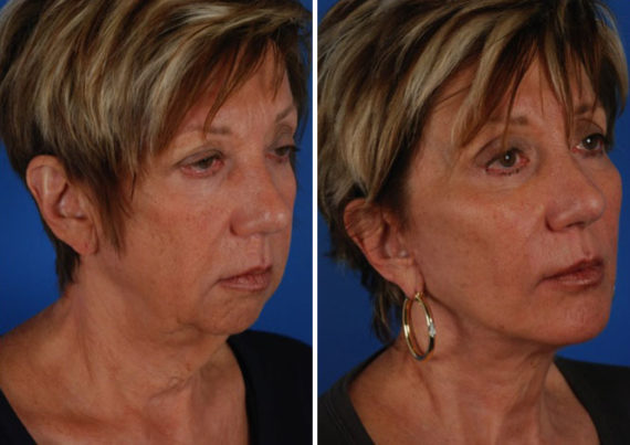 Endoscopic Facelift Before and After Photos in Naples, FL, Patient 8384