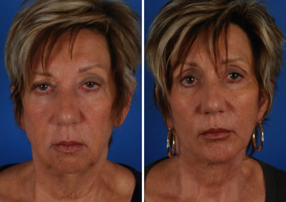 Endoscopic Facelift Before and After Photos in Naples, FL, Patient 8384