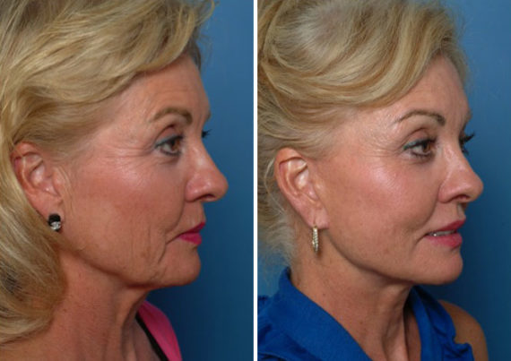 Endoscopic Facelift Before and After Photos in Naples, FL, Patient 8391