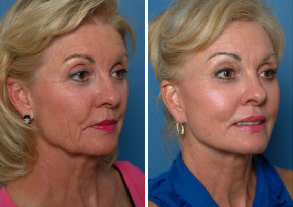 Endoscopic Facelift Before and After Photos in Naples, FL, Patient 8391