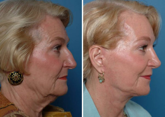 Endoscopic Facelift Before and After Photos in Naples, FL, Patient 8396